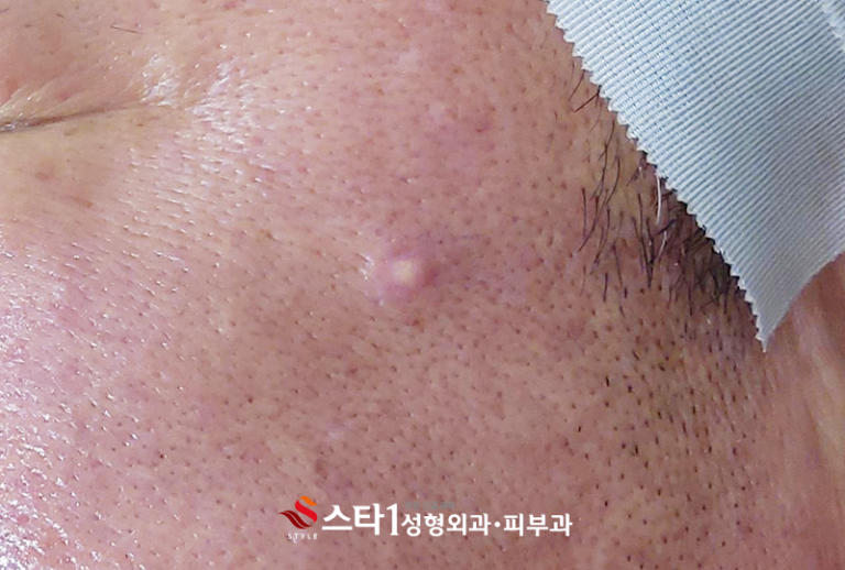 피지낭종이 생기는 이유 | 은평구성형외과 9
