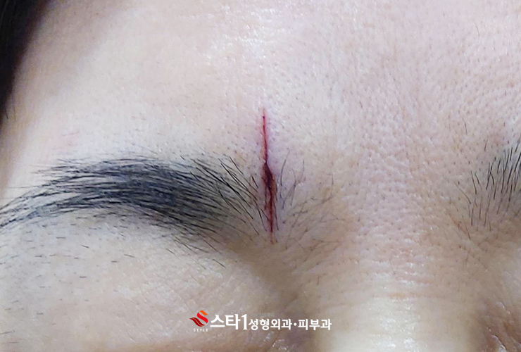 열상치료, 봉합수술 중요한 이유-연신내성형외과 1