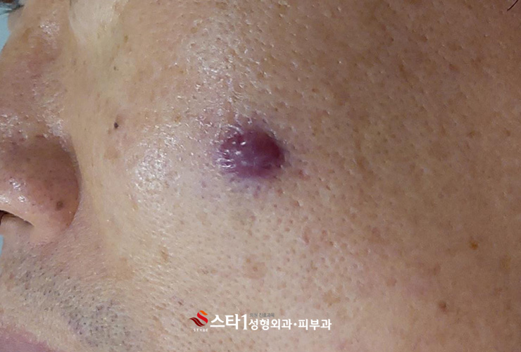혈관종 제거 후 관리도 중요 – 스타1성형외과