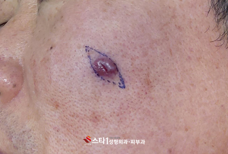 혈관종 제거 후 관리도 중요 - 스타1성형외과 2