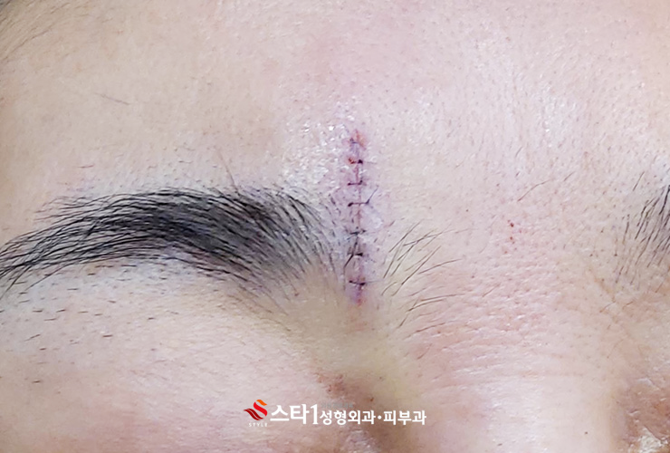 열상치료, 봉합수술 중요한 이유-연신내성형외과 3
