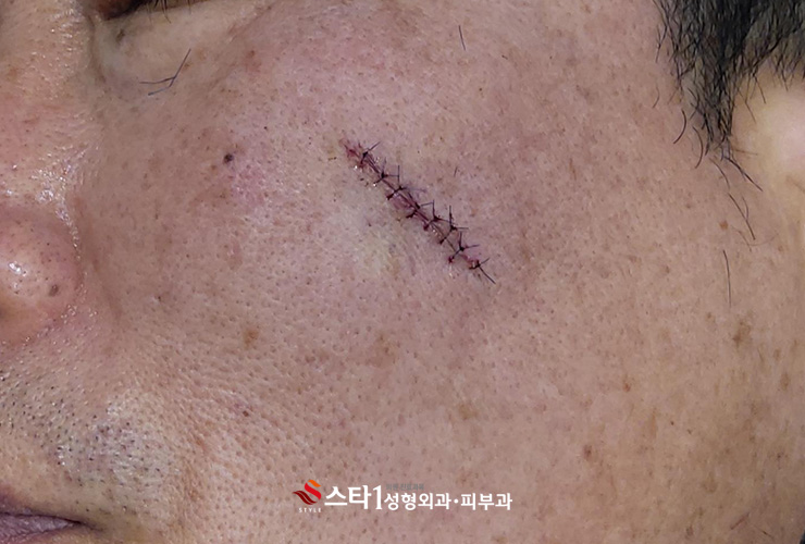 혈관종 제거 후 관리도 중요 - 스타1성형외과 3