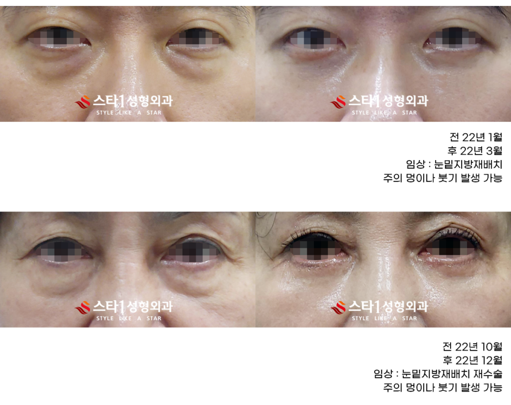 눈밑지방재배치 유지기간 어느정도일까-일산성형외과 2