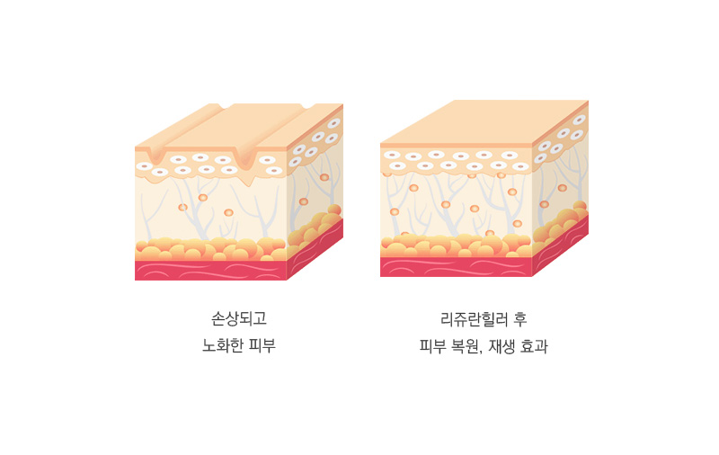 리쥬란힐러 효과 유지기간에 대해-홍제역피부과 2