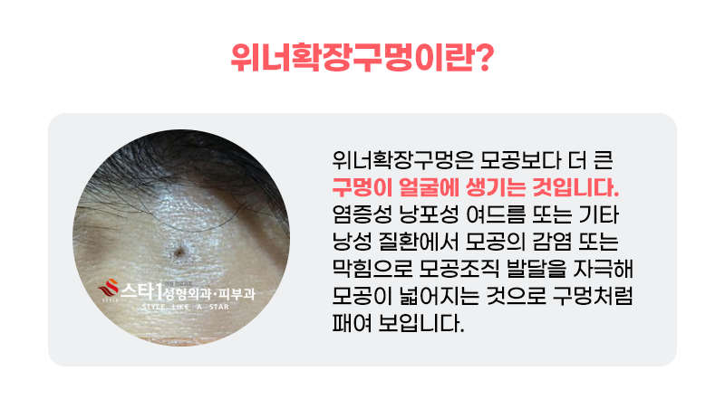 위너확장구멍 치료, 왜 생기고 어떻게 해결해야 할까 2