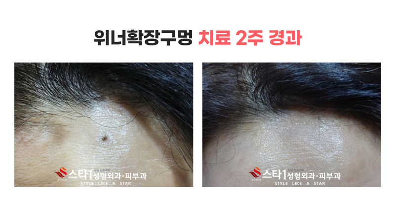위너확장구멍 치료, 왜 생기고 어떻게 해결해야 할까 3