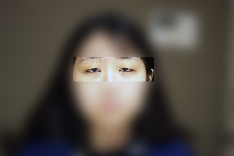 안검하수 눈매성형, 단순 쌍꺼풀과 무엇이 다를까 2