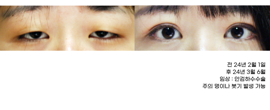 안검하수 눈매성형, 단순 쌍꺼풀과 무엇이 다를까 3