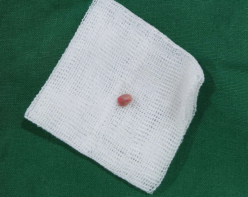 어깨 종기, 피지낭종일 수도 있는 이유 4