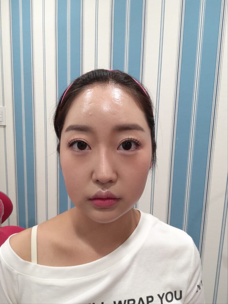 귀필러, 누운귀가 개선되는 방법은 무엇일까? 2