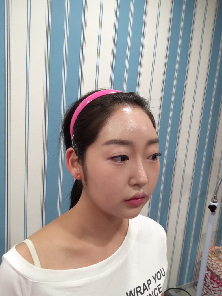 귀필러, 누운귀가 개선되는 방법은 무엇일까? 3