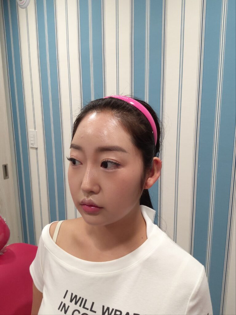 귀필러, 누운귀가 개선되는 방법은 무엇일까? 4