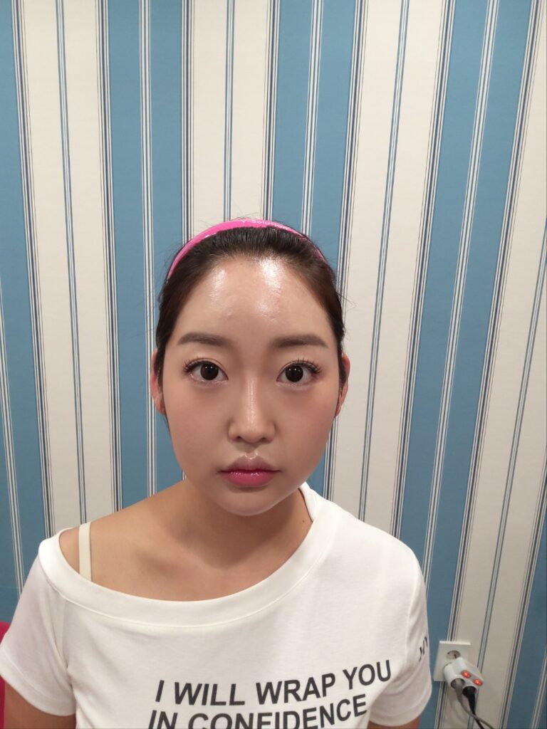 귀필러, 누운귀가 개선되는 방법은 무엇일까? 7