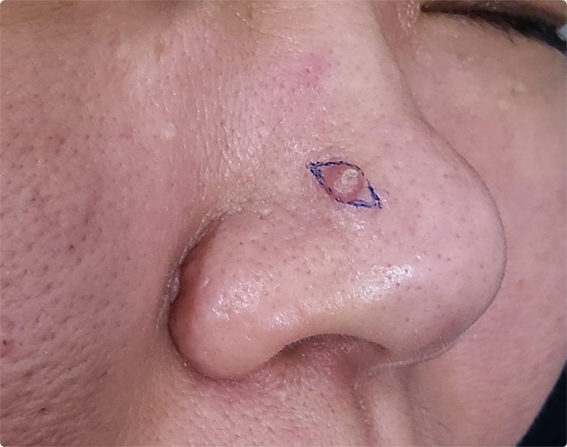 코 종물 제거, 단순한 혹으로 생각하면 안 되는 이유 2
