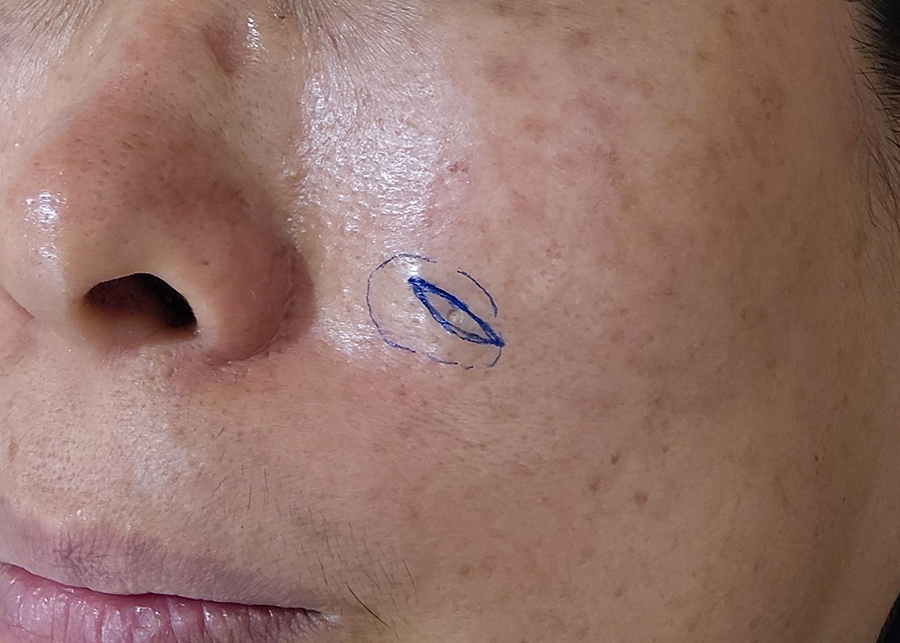 볼 피지낭종 제거, 방치하면 안 되는 이유는 무엇일까? 2