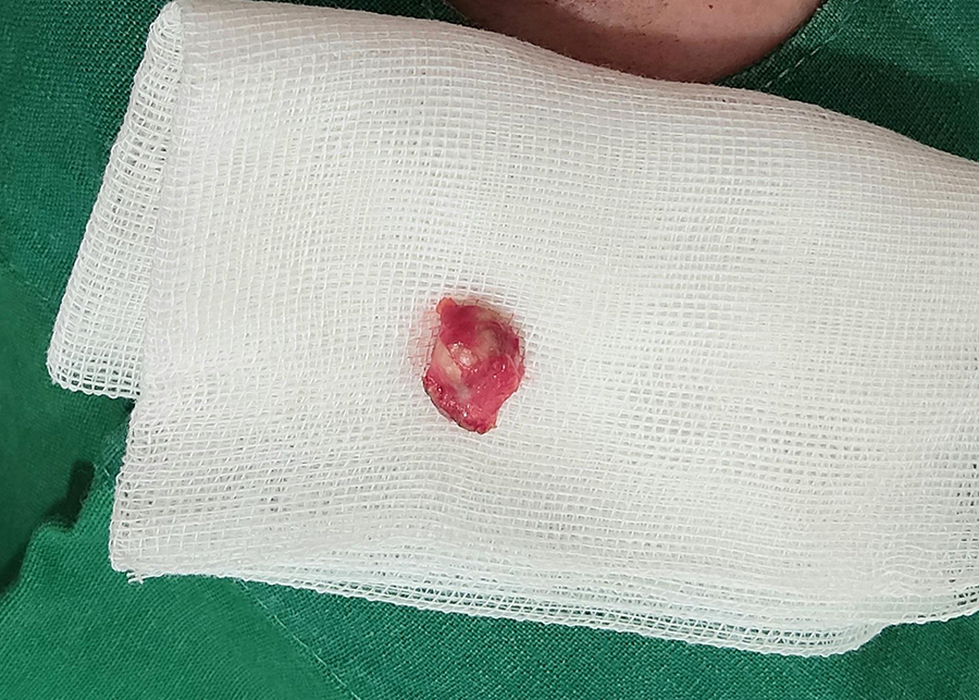 볼 피지낭종 제거, 방치하면 안 되는 이유는 무엇일까? 4