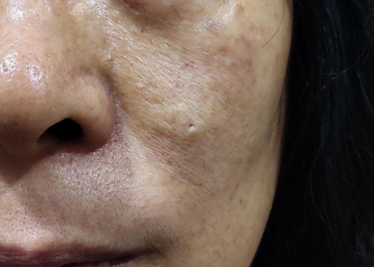볼 피지낭종 제거, 방치하면 안 되는 이유는 무엇일까? 6