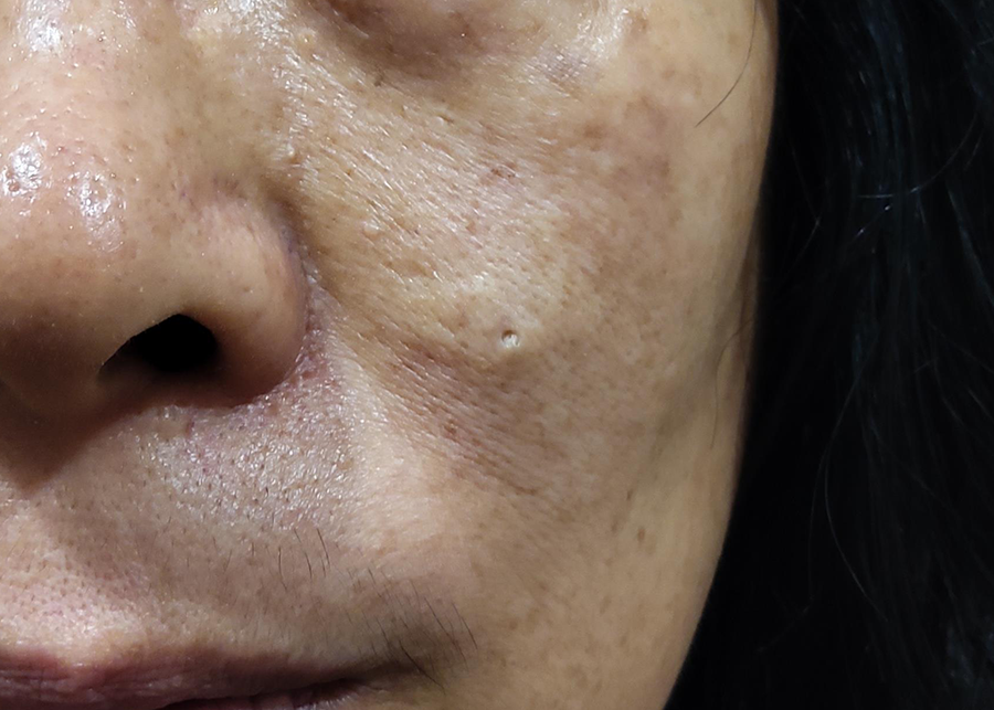 볼 피지낭종 제거, 방치하면 안 되는 이유는 무엇일까? 1