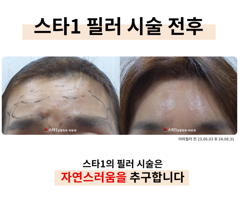 은평구 성형외과, 필러 퀄리티가 좋은 이유는 무엇일까? 3