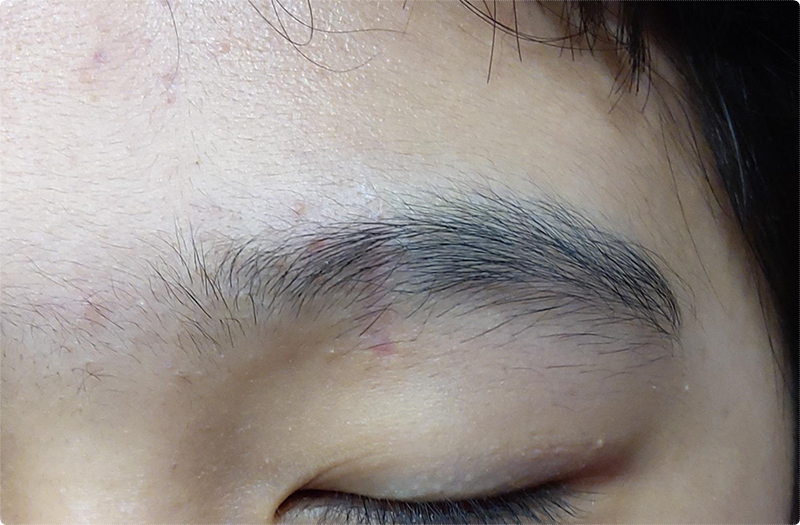 열상봉합, 변연절제술이 필요한 이유는 무엇일까? 5