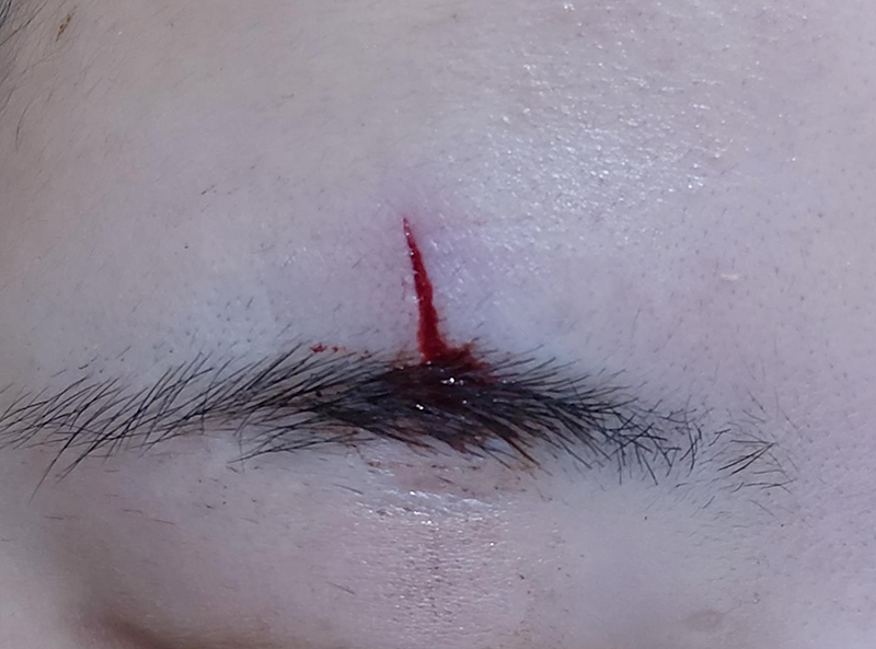 눈썹 찢어짐, 성형외과 봉합술로 치료할 때 중요한 것은? 1