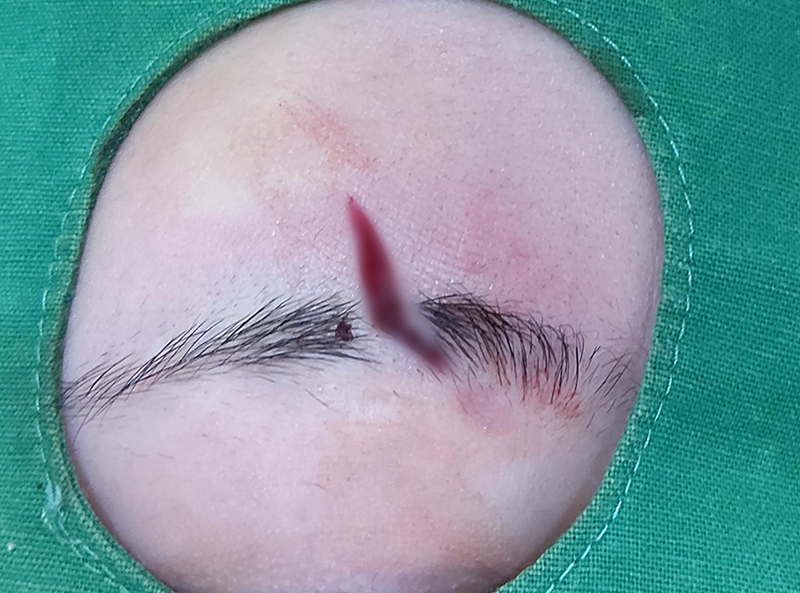 눈썹 찢어짐, 성형외과 봉합술로 치료할 때 중요한 것은? 2