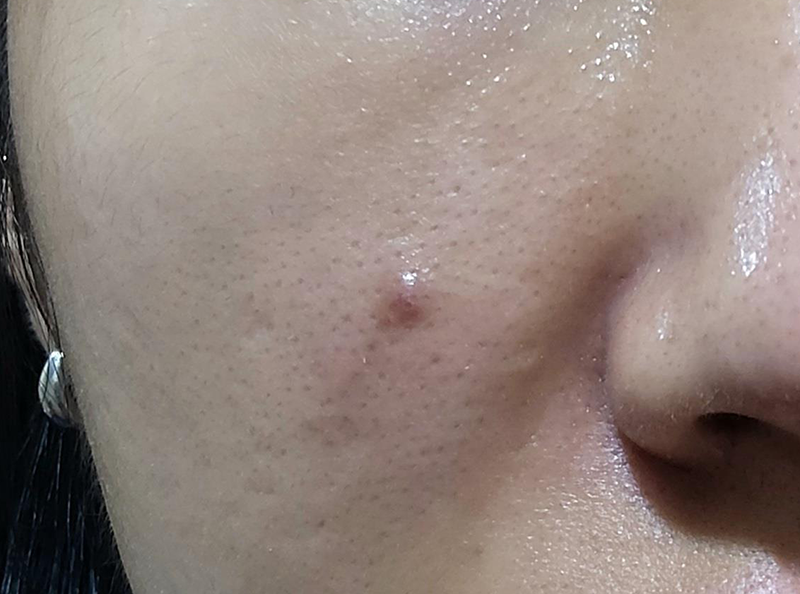 얼굴 신경섬유종 제거, 수술적으로 제거할 수 있을까? 1